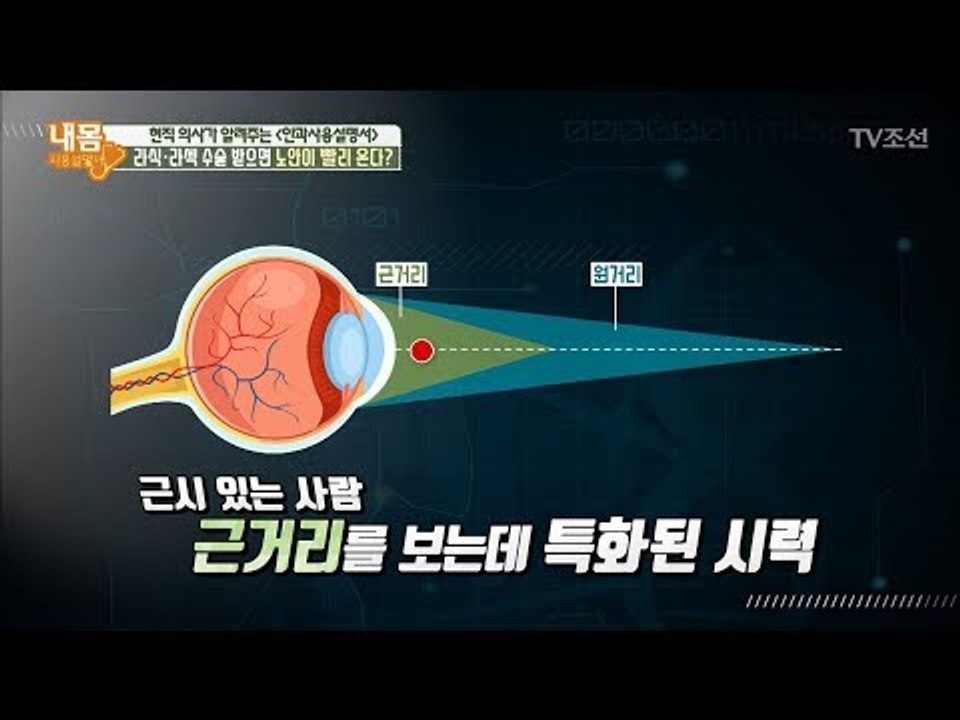라식, 라섹 수술을 받으면 노안이 빨리 온다? [내 몸 사용설명서] 192회 2018...