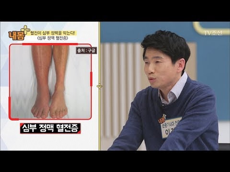 심부정맥이 이상신호를 보낸다? ‘갑자기 부은 한쪽 다리’ [내 몸 플러스] 93회 2...