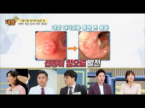 대장 내시경으로 보는 용종의 실체! [내 몸 플러스] 99회 20180429