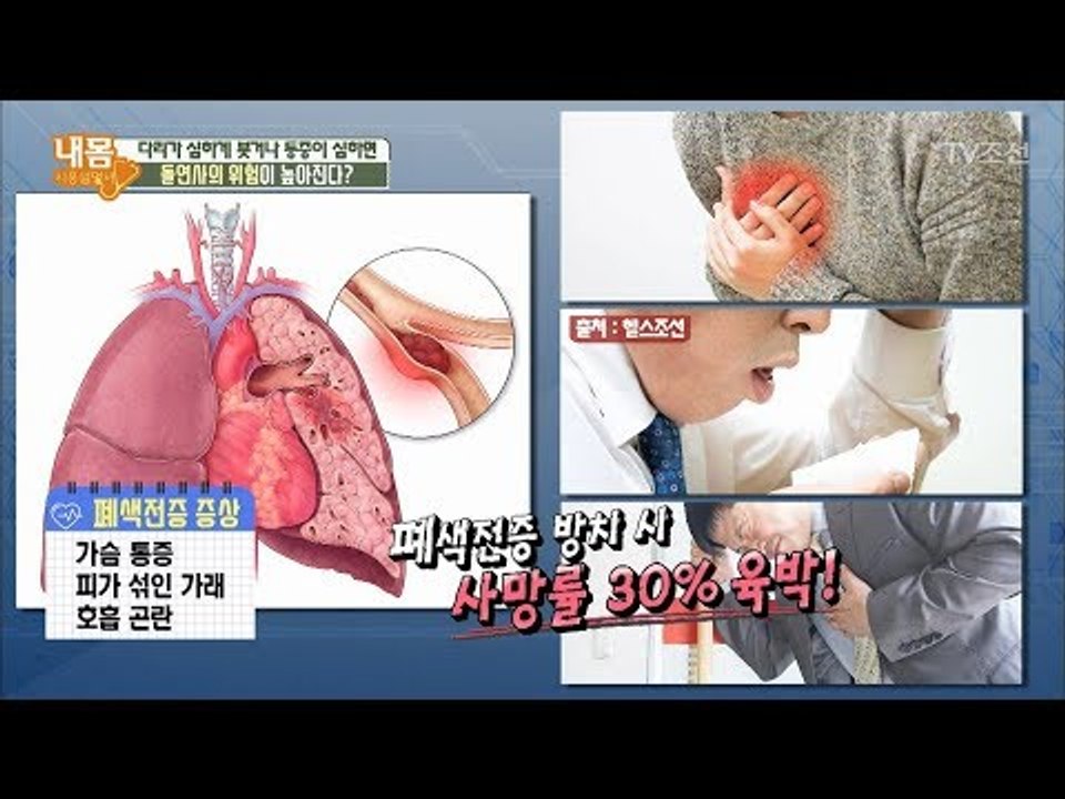 다리 통증과 붓기 방치하면 돌연사의 위험까지?! [내 몸 사용설명서] 210회 201...
