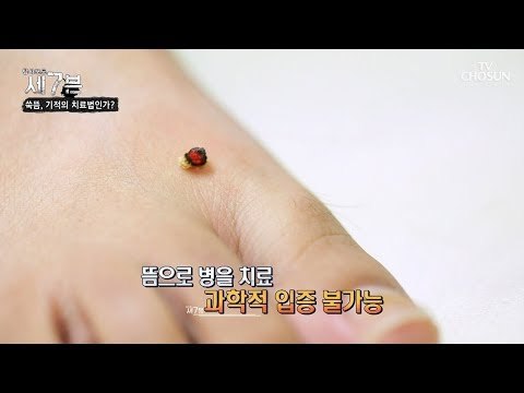 과학적 입증이 불가능해 앞으로 계속 논란이 될 뜸 치료 [탐사보도 세븐 49회] 20180822