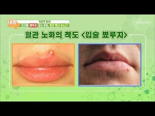 혈관 늙음의 지름길?! 입가 주변에 생기는 빨강색은 무엇?! [내 몸 사용설명서] 219회 20180921