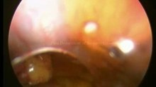 Lap Appendectomy