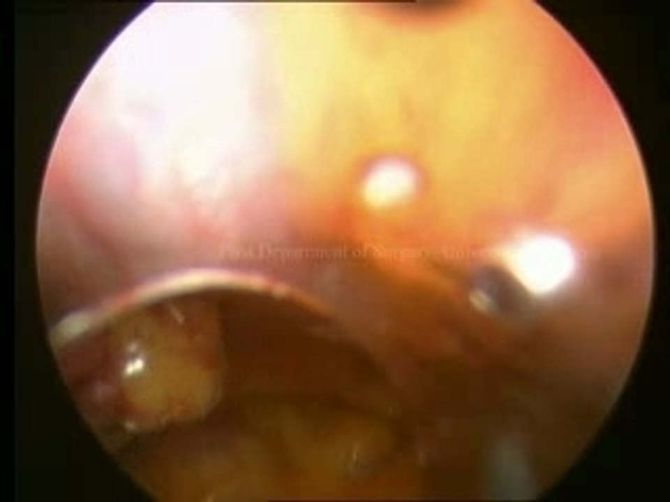 Lap Appendectomy