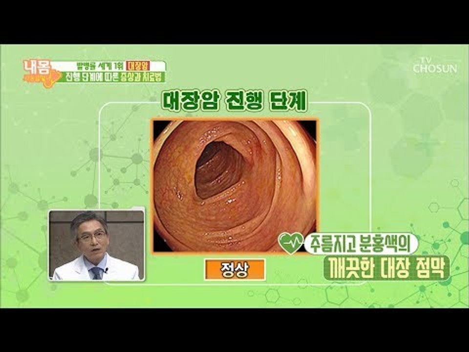 소리 없이 찾아오는 대장암! 단계별 모습은? [내 몸 사용설명서] 232회 20181221