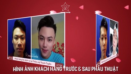 Hình ảnh khách hàng trước và sau phẫu thuật nâng mũi (BS Tuyền)