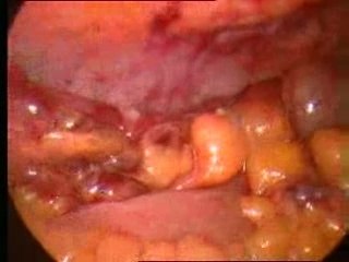 Lap appendectomy with stapler