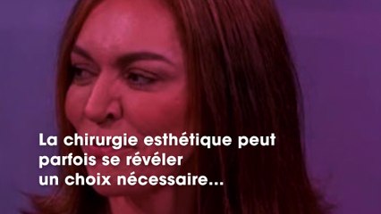 Le nez de cette femme grossit de façon incontrôlable, aujourd’hui elle est méconnaissable