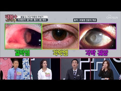 실명 유발하는 눈 질환? 눈에도 중풍이 온다! [내 몸 플러스] 134회 20190303