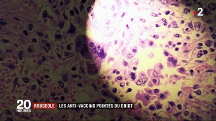 Rougeole : les anti-vaccins pointés du doigt