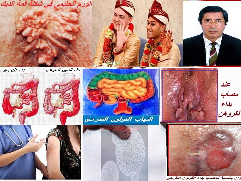 Rapports sexuels anaux , MST , RCH et CROHN الجنس الشرجي -  داء القولون الاتقرحي و ا لكروهن