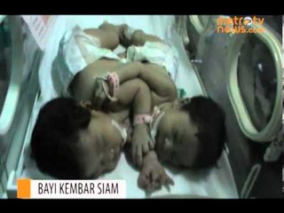 Bayi Kembar Siam Menanti Biaya Operasi