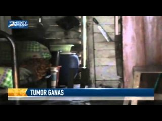 Penderita Tumor Ganas Ini Butuh Bantuan