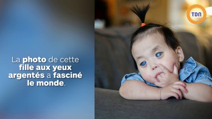 La fillette aux yeux en argent a dû se faire retirer les yeux pour mettre fin à ses souffrances !