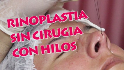 RINOPLASTIA O RINOMODELACION CON HILOS: un cambio en tu nariz sin entrar a quirofano.