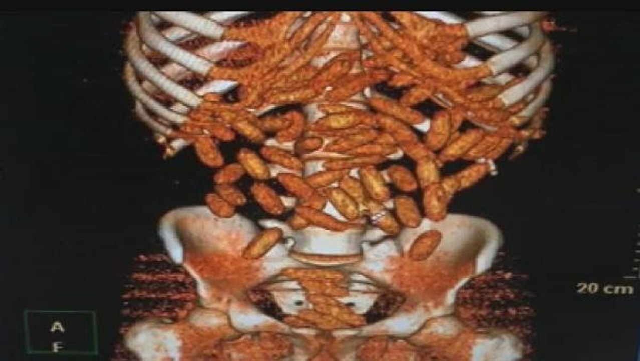 Polisin Şüphelenerek Durduğu Yolcunun Midesinden Piyasa Değeri 200 Bin Lira Olan Uyuşturucu Çıktı