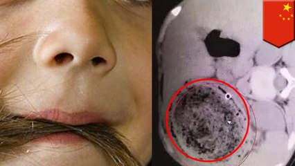 少女の胃から重さ1.5キロの髪の毛の塊が見つかる - トモニュース
