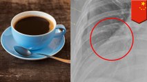 7年間、1日に10杯のコーヒーを飲み続けた30歳の女性 咳で肋骨3本が折れる - トモニュース