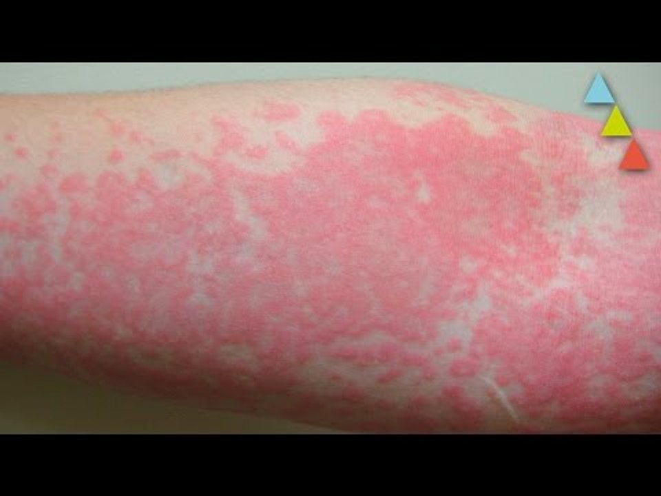 Las 10 alergias más raras del mundo
