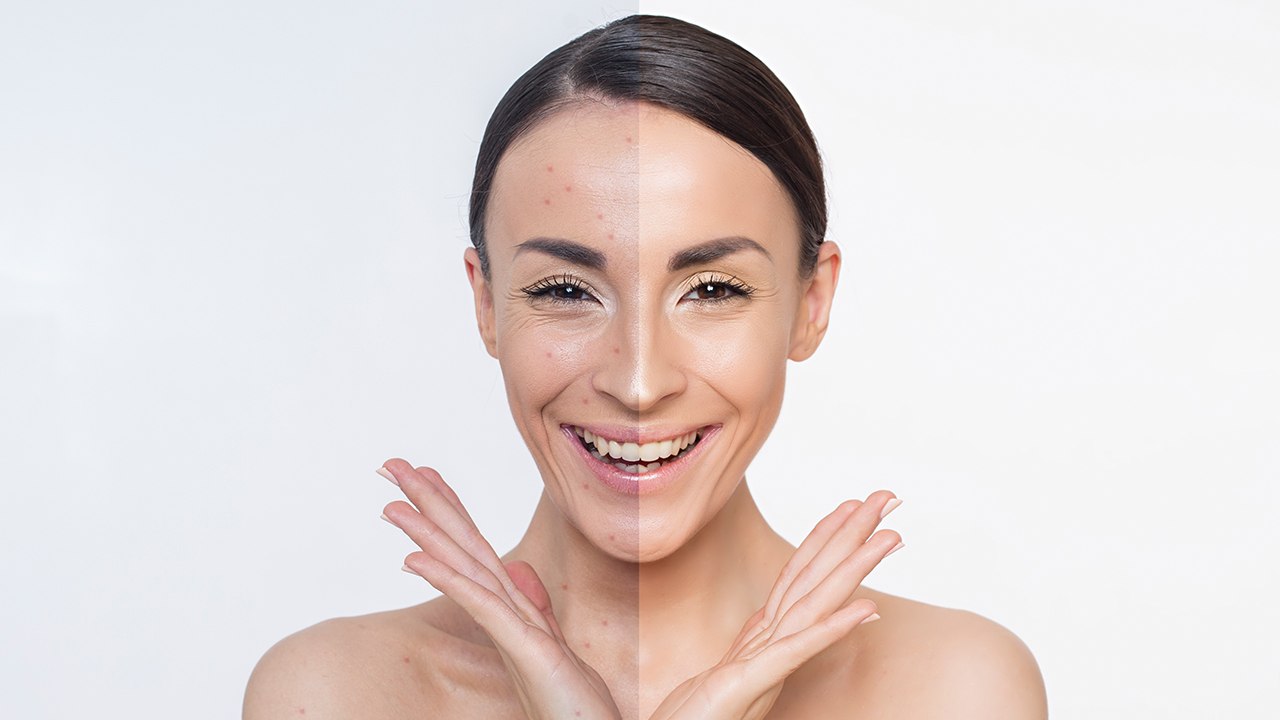 Akne? Das sind die besten Naturprodukte!