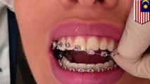 Bibir wanita terkena infeksi gara-gara kawat gigi palsu - TomoNews