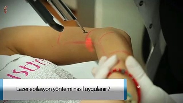 Lazer Epilasyon Yöntemi Nasıl Uygulanır?