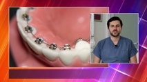 Telsiz diş çarpıklığı tedavi yöntemleri nelerdir?