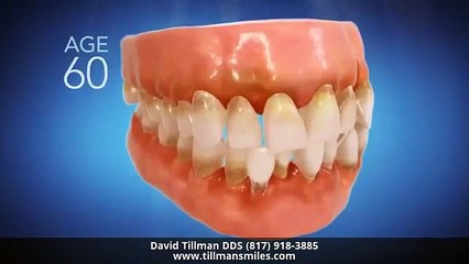 Invisalign Dentist Fort Worth TX