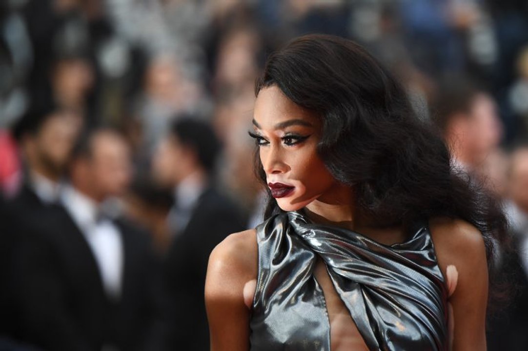 Welche Stars haben Vitiligo?