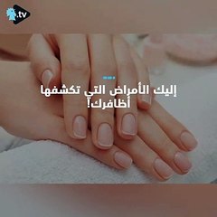 إليك الأمراض التي تكشفها أظافرك!