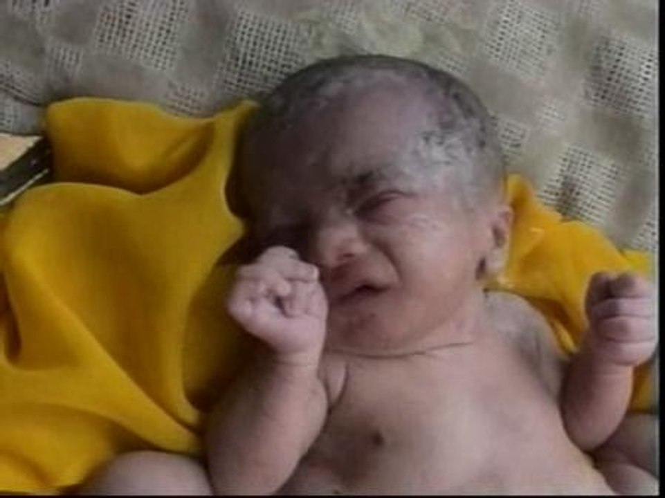 Nacen en la India unos gemelos que comparten tronco