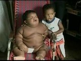 Un bebé colombiano de 11 meses pesa 28 kilos