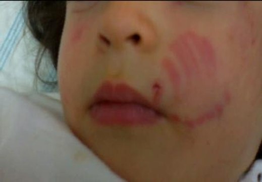 Una niña de 22 meses recibe 30 mordiscos en la guardería