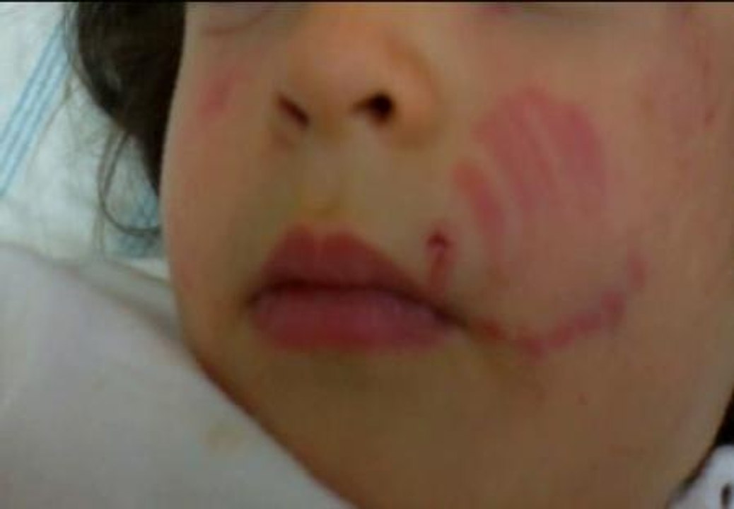 Una niña de 22 meses recibe 30 mordiscos en la guardería