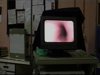 Comida picante y cáncer de estómago