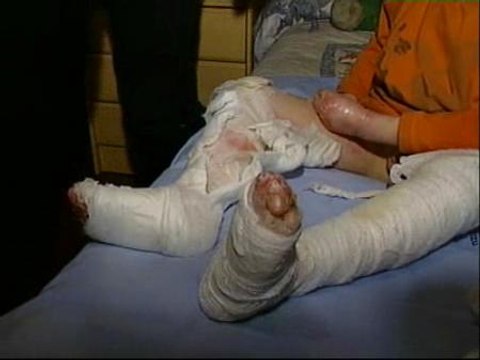 Los médicos buscan soluciones para la Piel de mariposa