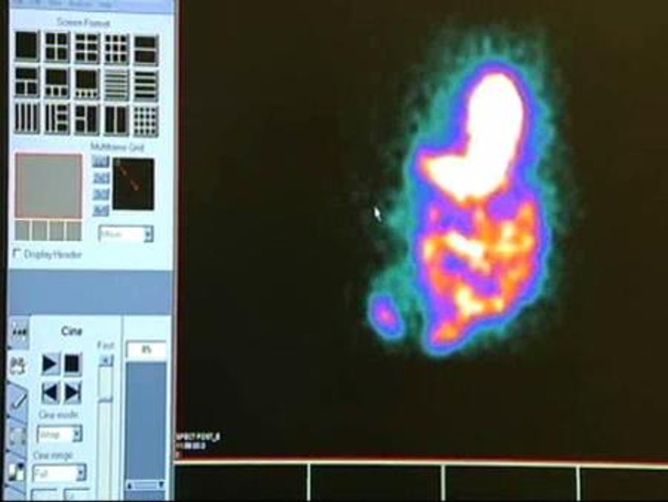 Descubren las propiedades contra la obesidad de un fármaco usado para otros fines