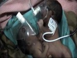 Dos siameses indios unidos por el estómago sobreviven a una operación