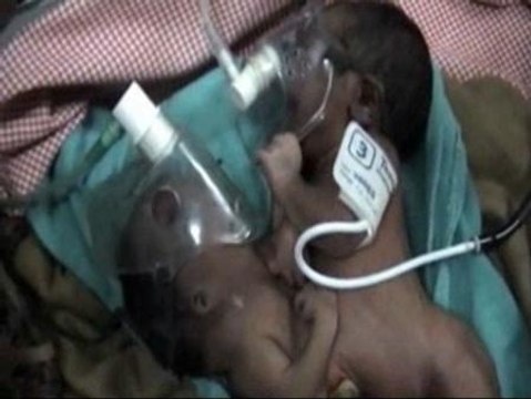 Dos siameses indios unidos por el estómago sobreviven a una operación