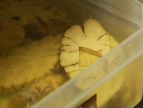 Aumenta la donación de cerebros en España