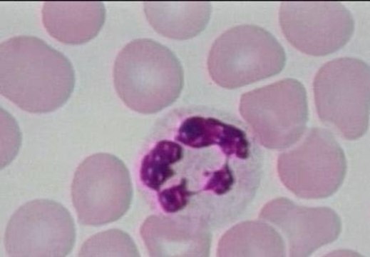 Un grupo de investigadores españoles consigue descifrar el genoma de la Leucemia Linfática Crónica