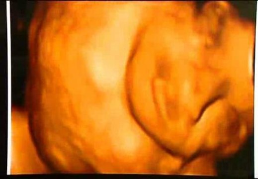 Operado con éxito un feto con un tumor de grandes dimensiones