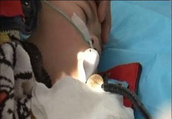 Extraen una moneda alojada en el estómago de un niño de 6 años