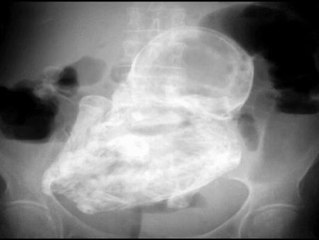 Hallan un feto calcificado hace 40 años en el vientre de una anciana