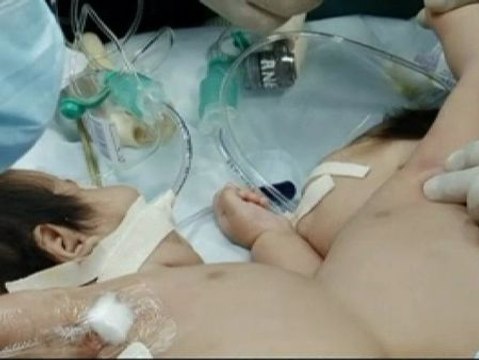 Separan con éxito a unas siamesas en Perú