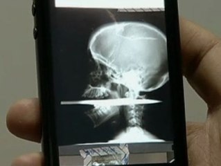 Una brasileña sobrevive al disparo de un arpón que le atravesó la boca y la médula espinal
