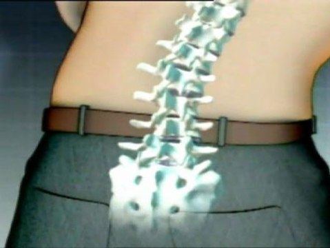 Cómo será la operación de hernia discal del rey