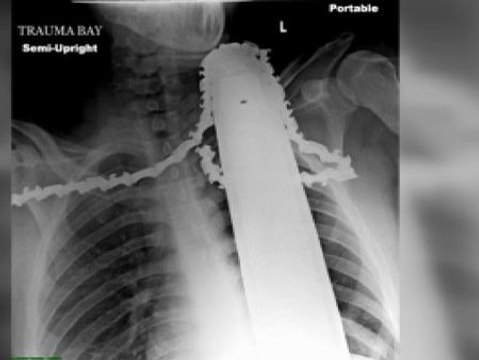 Un joven se hiere con una motosierra mientras trabajaba como podador