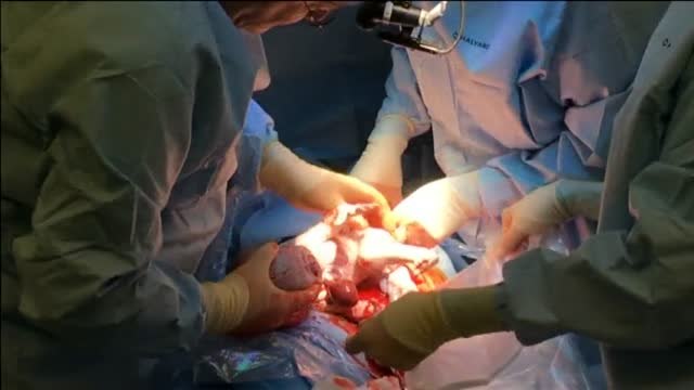 Operada con éxito la bebé que nació con el corazón fuera del pecho