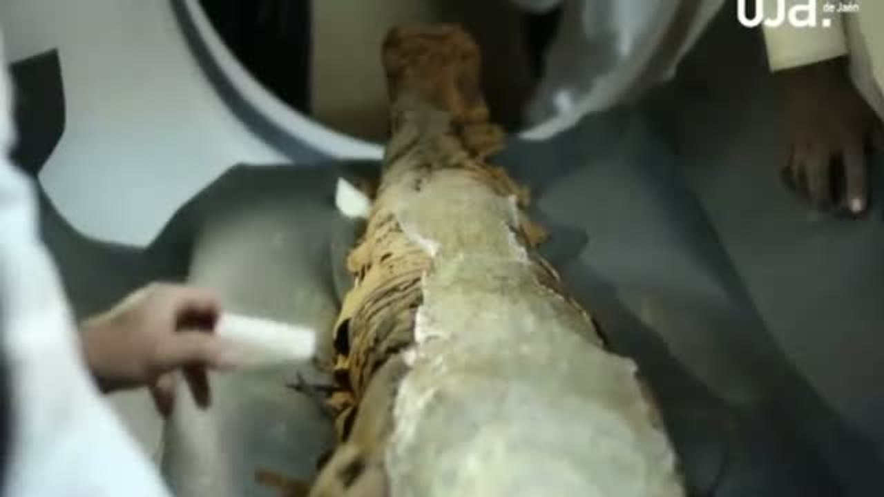 El cáncer de mama más antiguo del mundo tiene 4.000 años